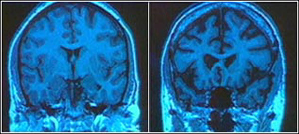 images irm cerveau